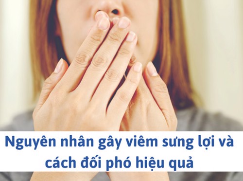 Nguyên nhân gây viêm sưng lợi và cách đối phó hiệu quả